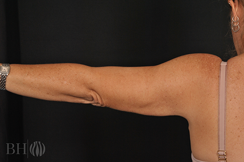 Arm Lift Before & After